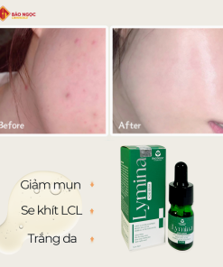 acne lymina 1