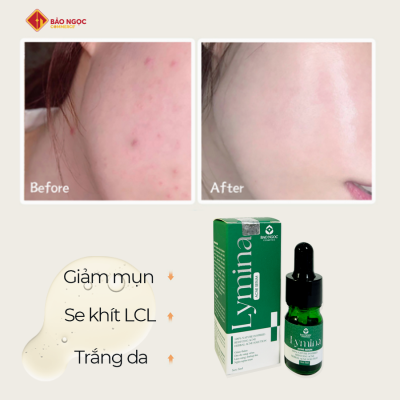 acne lymina 1